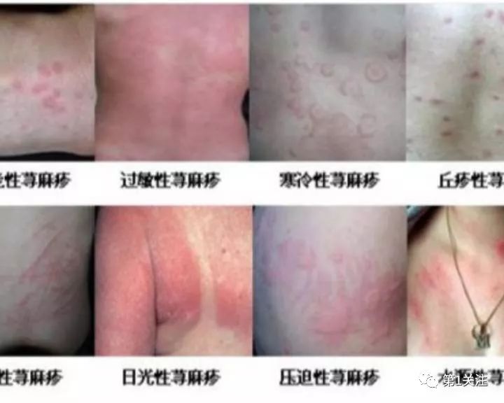 【健康赣州】教你几招:如何预防秋季荨麻疹?