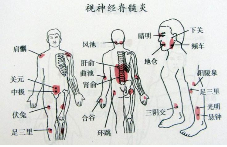 腰椎间盘突出症的中医特色疗法,一学就会