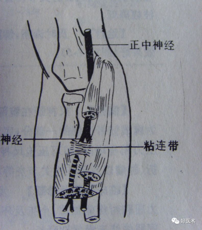 骨间前神经为纯运动支,无感觉神经纤维.