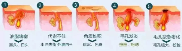 粗毛孔怎么办