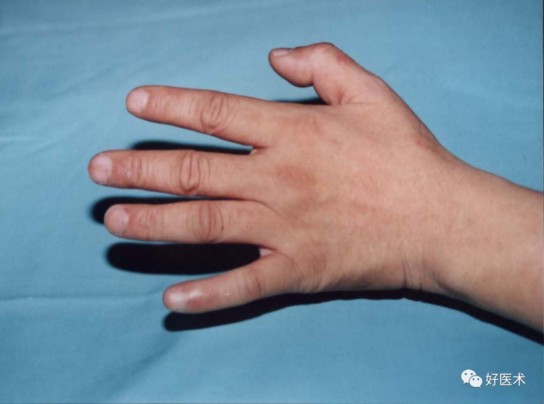 手掌背侧感觉正常 手内在肌肌萎 肌力减退 爪形手 询问病史 手部运动