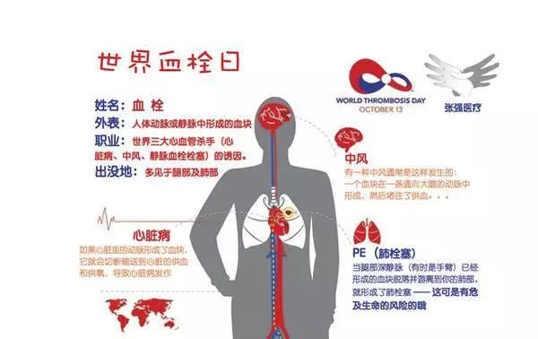 (视频)世界血栓日—"拴不住 动起来"_预防