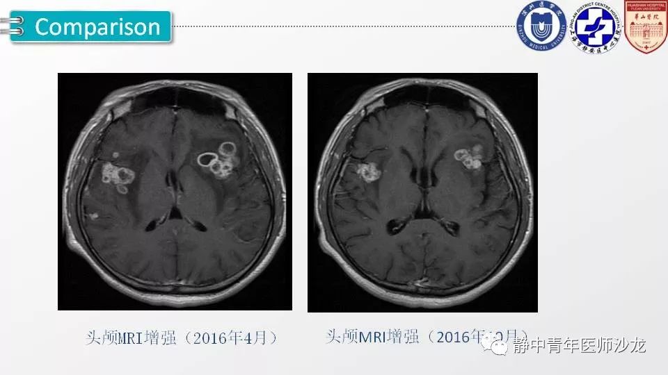 原创一例结核性脑膜炎病例的影像学分析