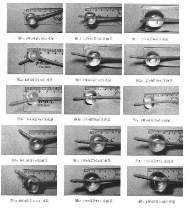 导尿管水囊内到底该注入多少水?10ml?15ml?