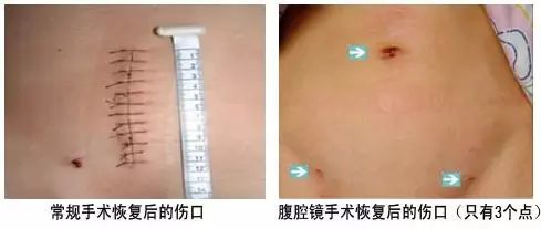 靖边县人民医院引进 最先进电子腹腔镜系统