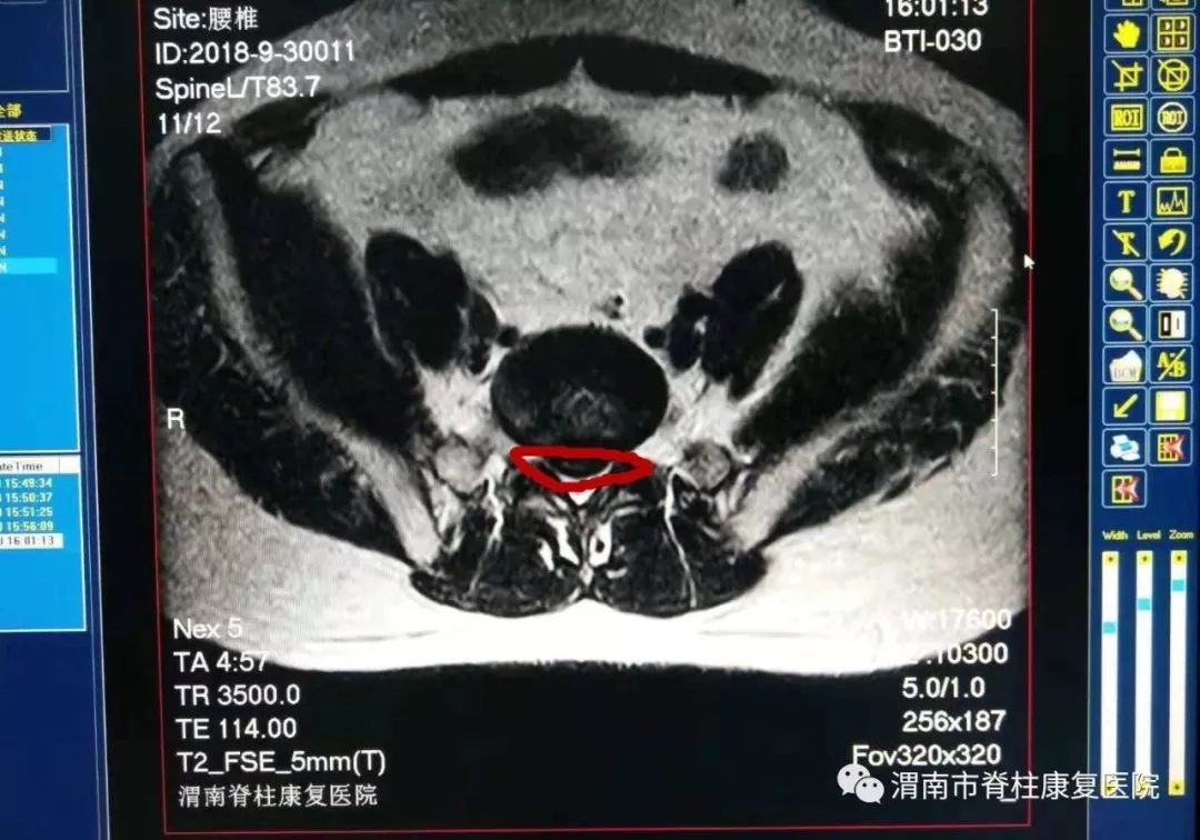 dr拍片显示腰椎巨大突出物(红色画圈部分)