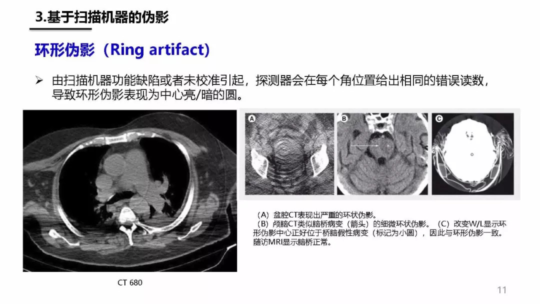 ct伪影产生机制及图像表现,您都清楚了吗?