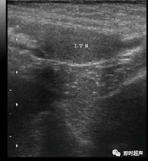 【病例】16岁男生左侧阴囊空虚,申请超声检查_睾丸