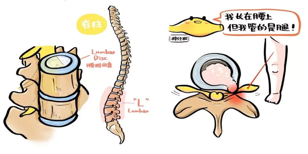 腰椎间盘后方就是发射至腿的神经,鼓包了肯定就会压着后边的神经了