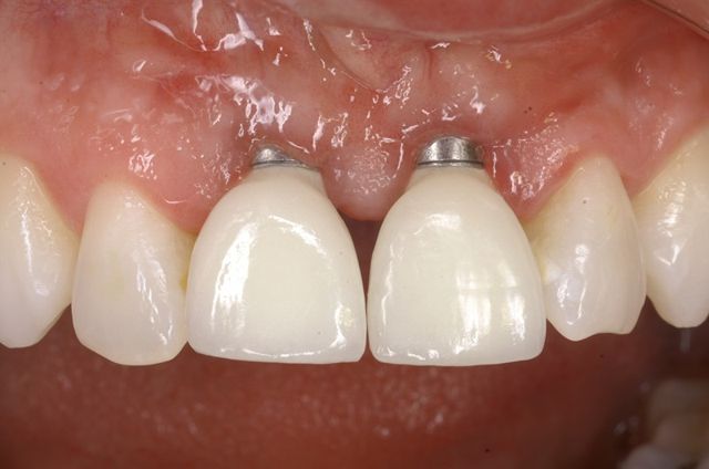 创伤人工种植牙手术中的机械性创伤及热灼伤是影响种植成功的一个重要