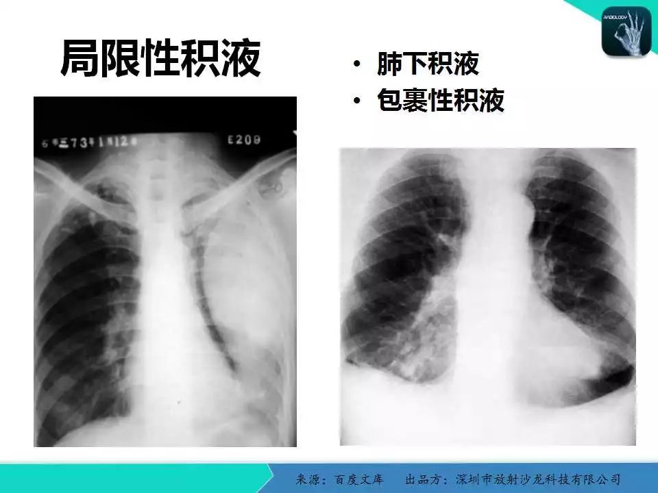 精品课件| 胸x片读片全面分析与肺部常见病的x线诊断
