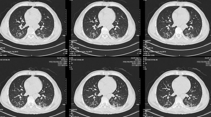 图4 胸部ct,提示肺部感染合并少量胸腔积液.