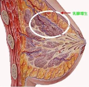 20-30岁 乳腺结节是乳房里的"肿块",九成是良性,但大部分是乳腺增生或