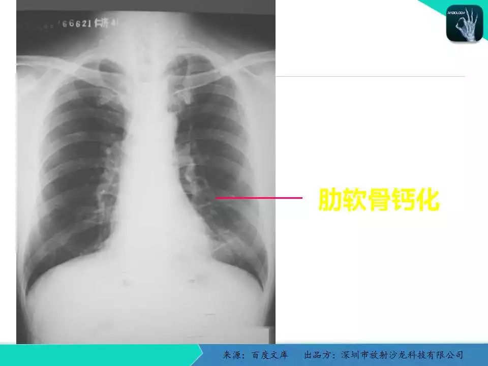 精品课件| 胸x片读片全面分析与肺部常见病的x线诊断