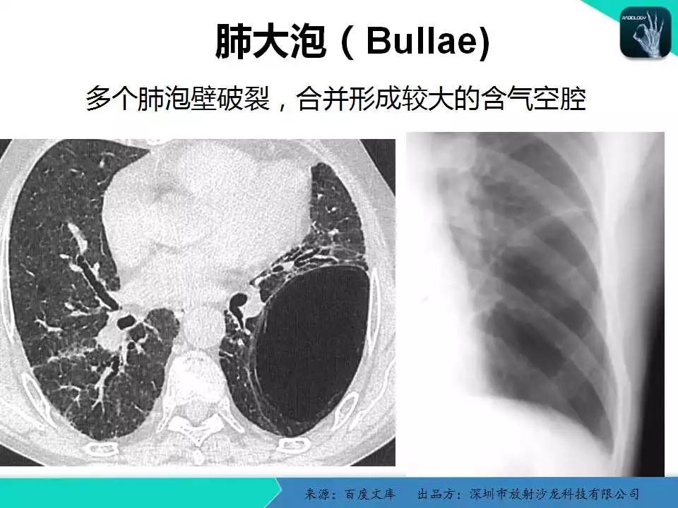 精品课件| 胸x片读片全面分析与肺部常见病的x线诊断