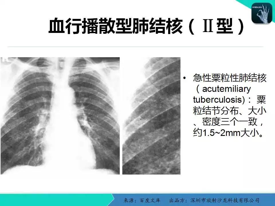 精品课件| 胸x片读片全面分析与肺部常见病的x线诊断