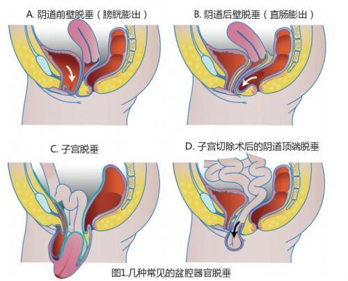 28岁小伙上厕所时玩手机,结果把肠子拉出来了_脱肛