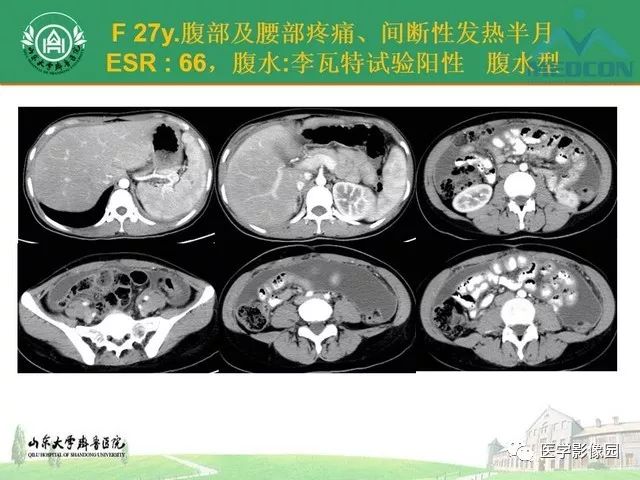 弥漫性腹膜病变的ct诊断及鉴别诊断影像天地