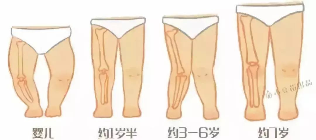 (图片来源:小豆苗) 至于o型腿,往往是由于过早站立,佝偻病等因素引起