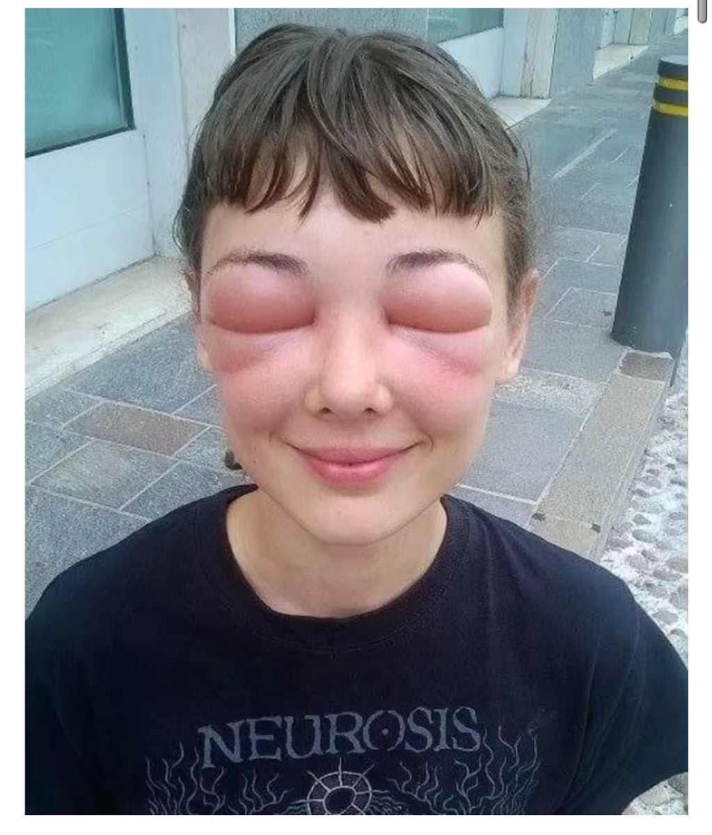 六张让人哭笑不得的照片,妹子眼睛被马蜂叮肿了确笑的
