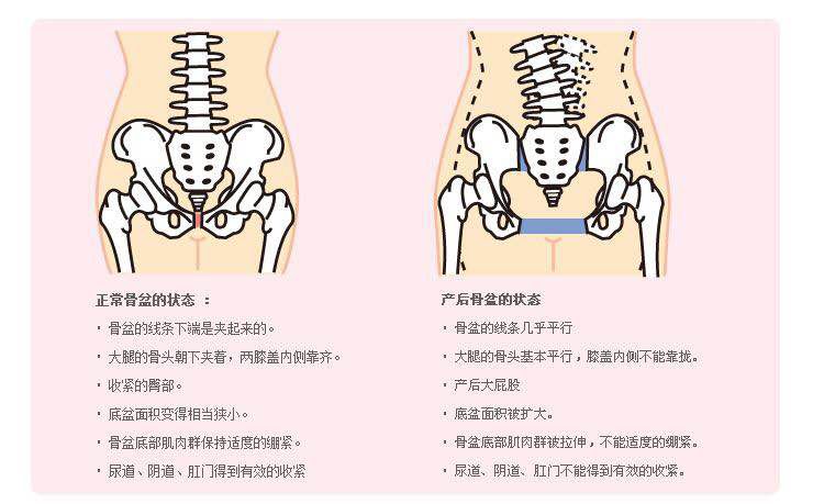 产科医生揭秘:被月子中心"神化"的盆底肌和骨盆修复,有必要做吗?