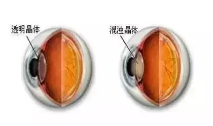 青光眼是一组以视神经损害和视野缺损为共同特征的眼科疾病.