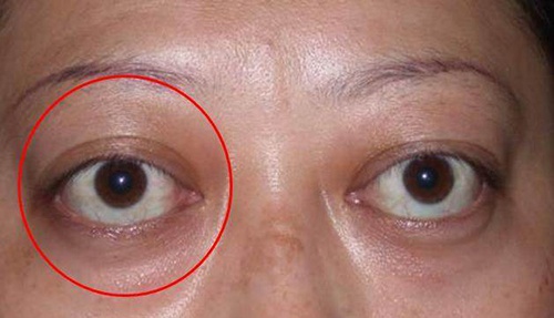 近视性突眼一般为假性眼球突出,多见于高度近视,由于眼轴过长,外观似