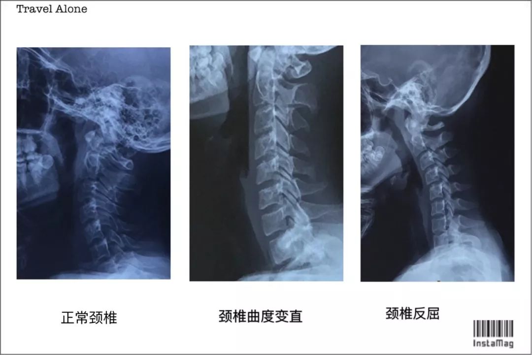 颈椎曲度变直大多数是因为久坐伏案长时间低头引起的,也有少数是由于