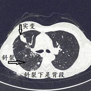 有钙化3 有小结节,且沿着支气管播散2 右肺病灶在结核好发部位(尖后段