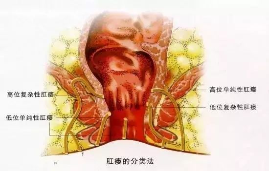 肛瘘的症状都有哪些呢?