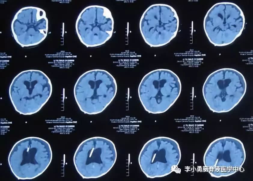 2014-1-6ct,脑室系统继续缩小,双侧硬膜下积液