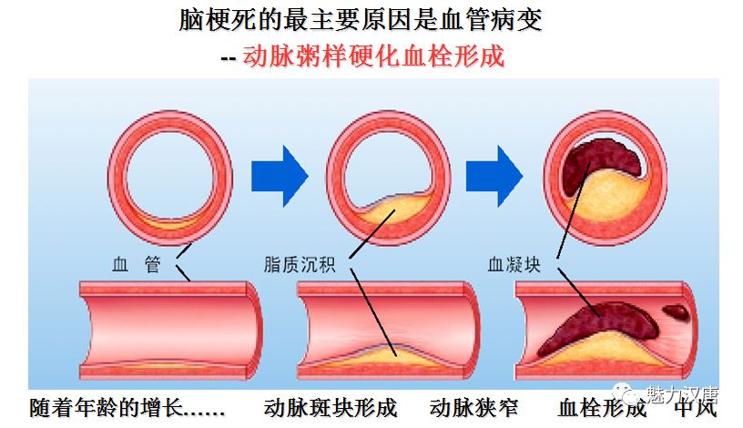 动脉粥样硬化血栓形成