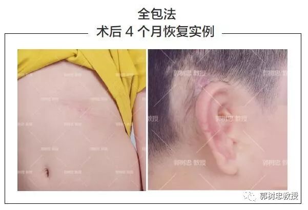 小耳症那些事儿(二十七)再造的耳朵有痕迹吗?