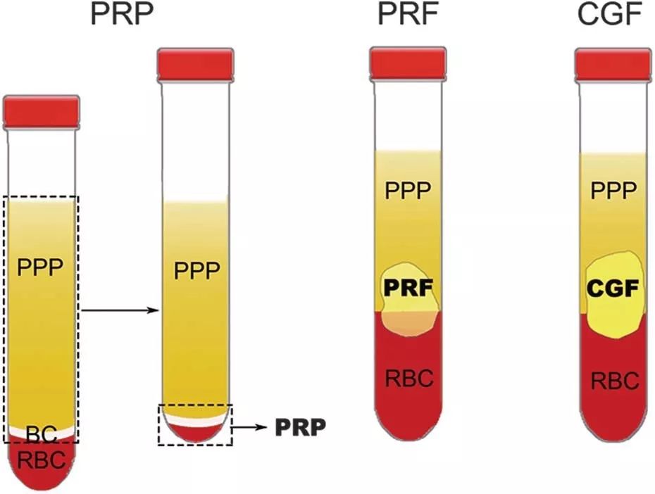 目前,常见的血小板制剂主要包括:prp(富血小板血浆,prf(富血小板纤维