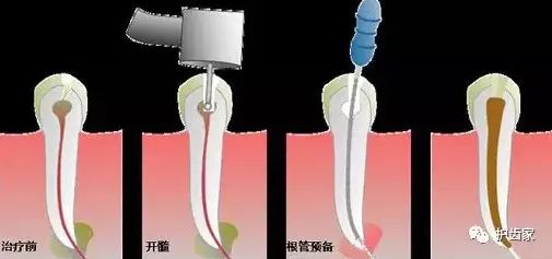 2,牙周炎引起