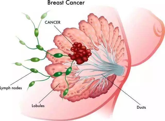 如何正确诊断和确诊乳腺癌肿瘤专家段汝钦教授为您解答