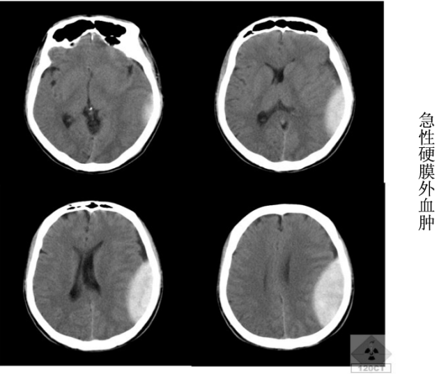 头颅ct解剖与常见出血梗死判读