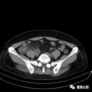 病例下腹疼痛回盲部结构紊乱阑尾临近见多发结节状软组织密度影