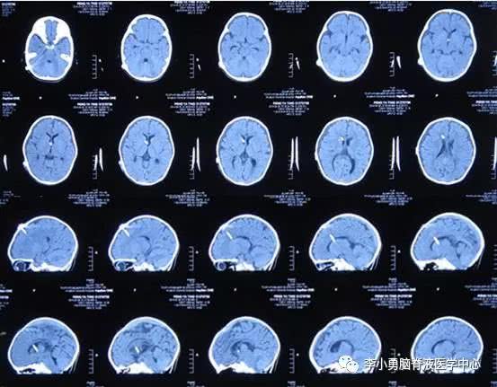 心疼,1岁多宝宝脑膜炎发热4个月疑似脑肿瘤,辗转9家医院!