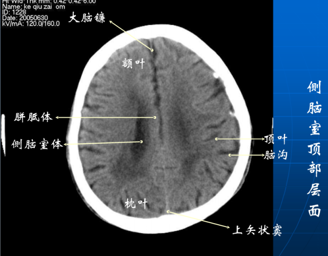 头颅ct解剖与常见出血梗死判读