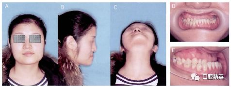 数字化技术在半侧颌骨肥大治疗中的应用1例报道