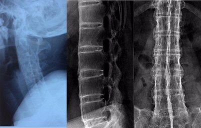 强直患者的脊柱出现"竹节状"的原因