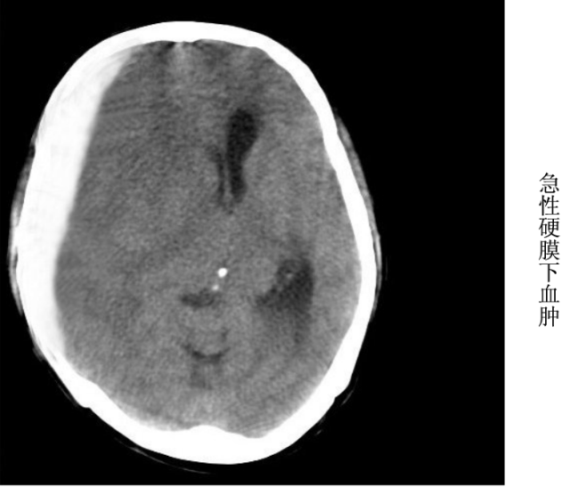 头颅ct解剖与常见出血梗死判读