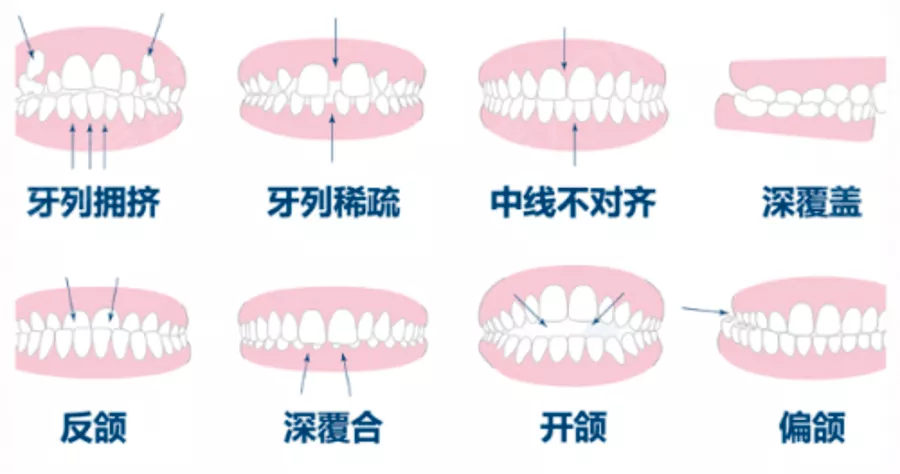 ▼▼▼  牙齿矫正也叫牙齿正畸,通常是通过口腔技术,修整牙齿排列不