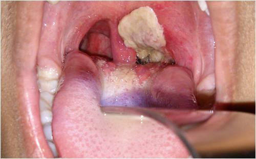 白喉的临床诊断通常依赖于覆盖咽部的灰色渗出物(假膜).