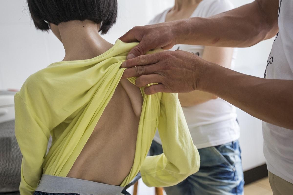 德宏中医提醒:小心腰椎间盘突出症导致脊柱侧弯