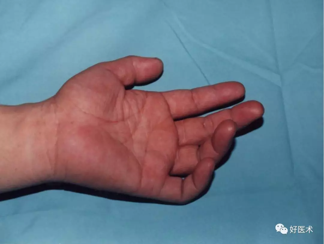 手掌背侧感觉正常 手内在肌肌萎 肌力减退 爪形手 询问病史 手部运动