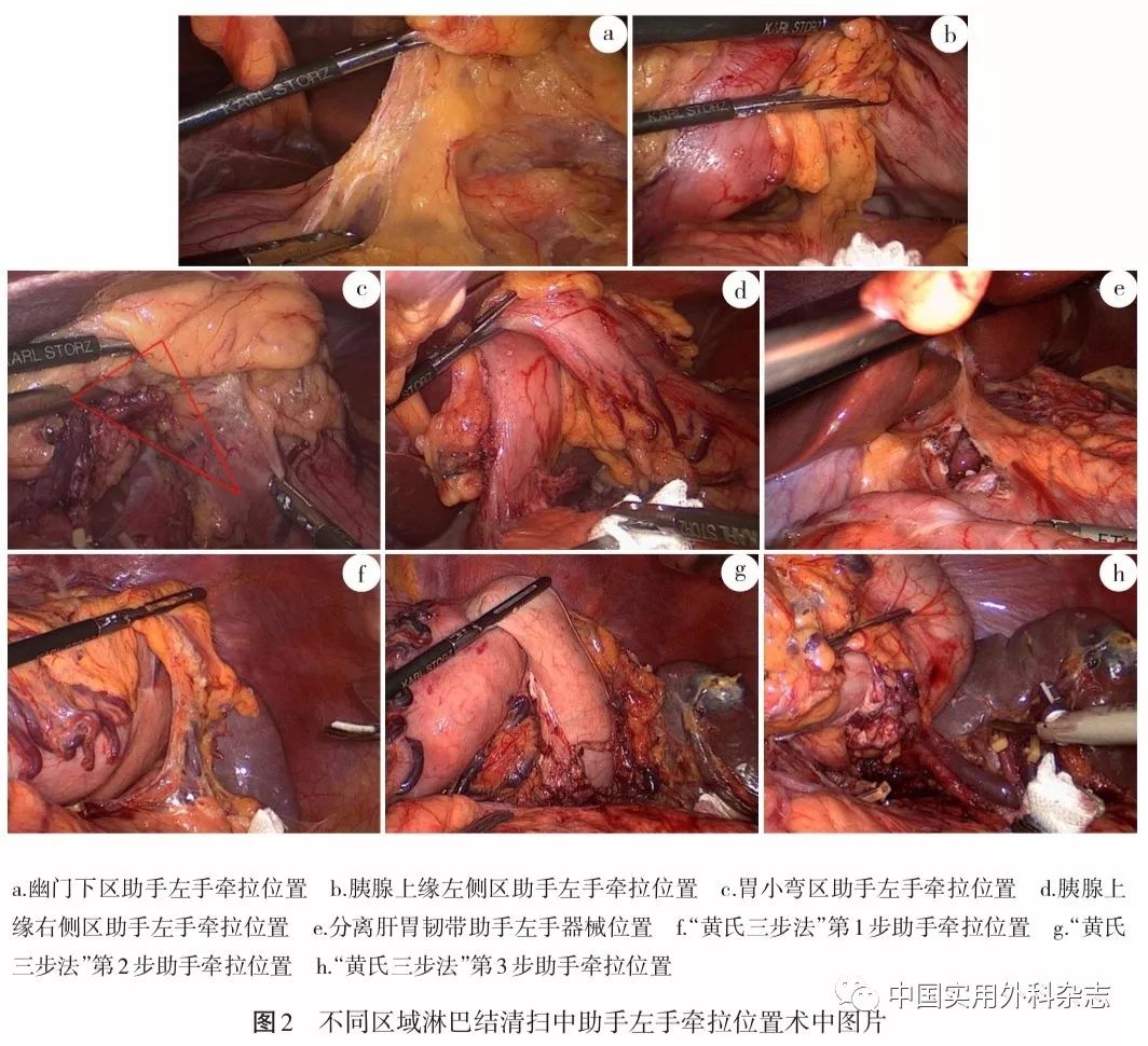 手术经验与技巧|腹腔镜胃癌根治术淋巴结清扫中功能型