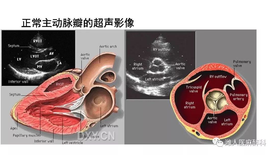 讲者:王绍明 主要内容:介绍了主动脉瓣狭窄的解剖,狭窄程度分级,病理