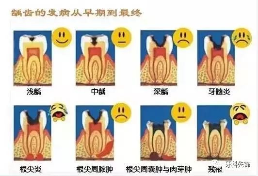 从牙齿上有小黑点到失去牙齿需要多久 口腔卫生